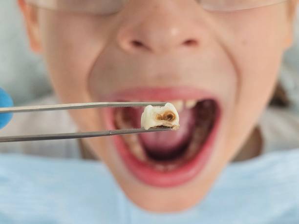 Emergency Dentist for Dental Implants
